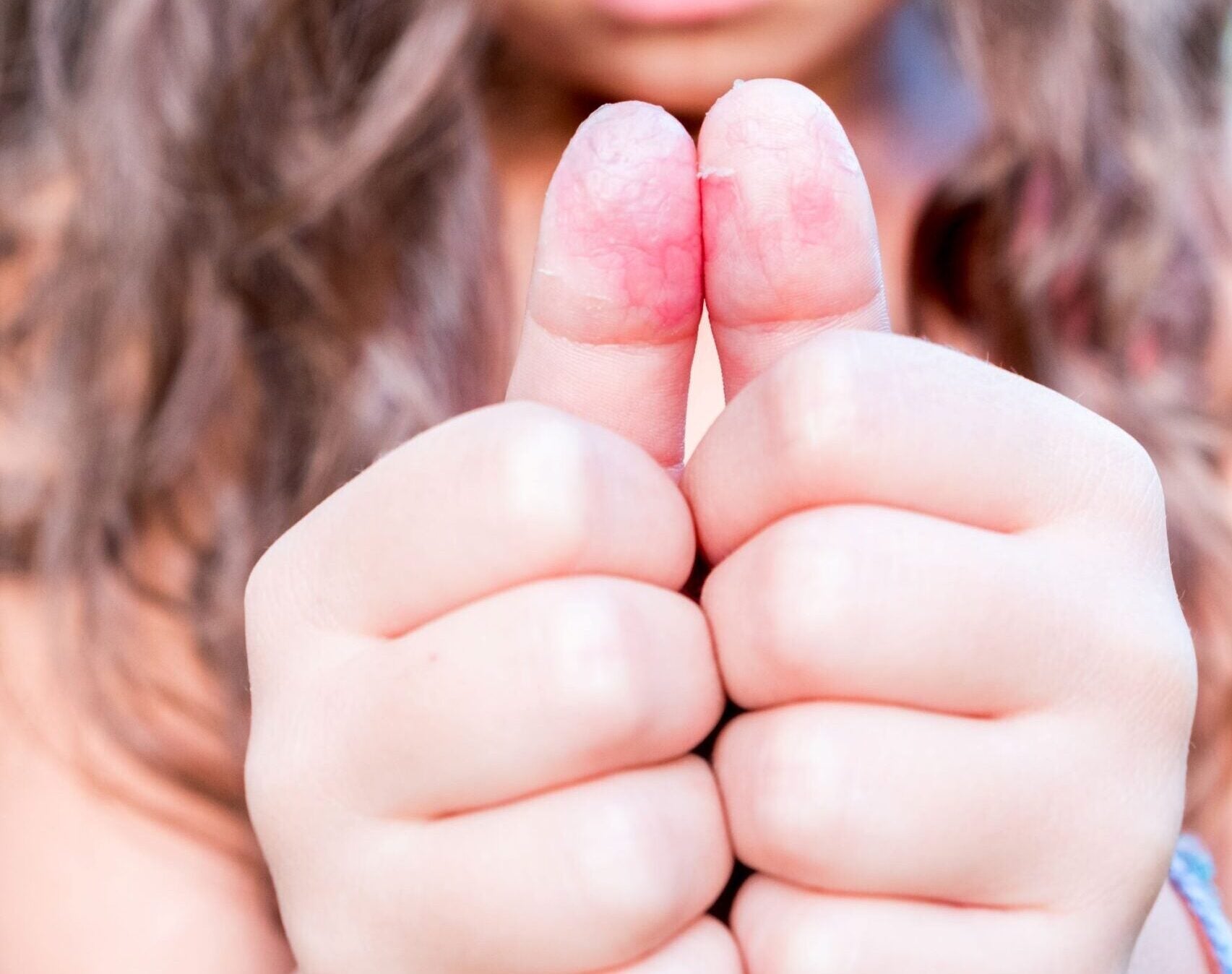 How to Treat Baby Eczema