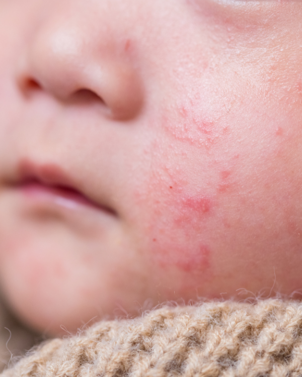 How natural skincare can help eczema